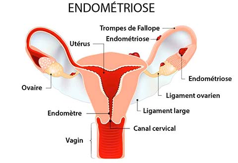 c'est quoi l'endometriose